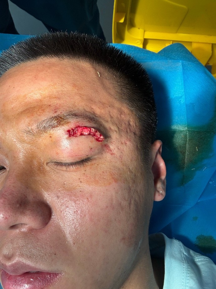 牛梓屹社媒晒眼部伤口照片：眼睛踢瞎了才会给红牌吗？