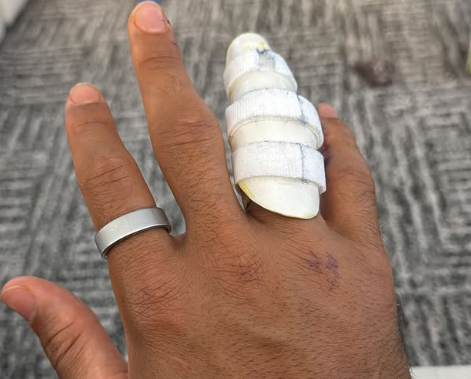 哈特晒无名指手术治疗后照片，并透露护具需要戴6周